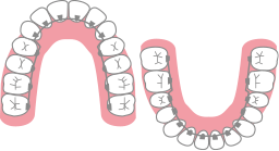 リンガルブラケット（舌側矯正）