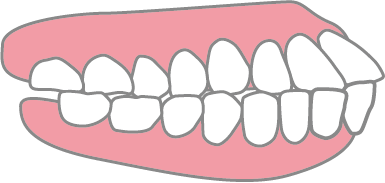 治療前の上下顎前突