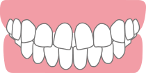 歯の捻れ