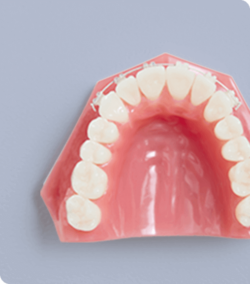 前歯の部分矯正