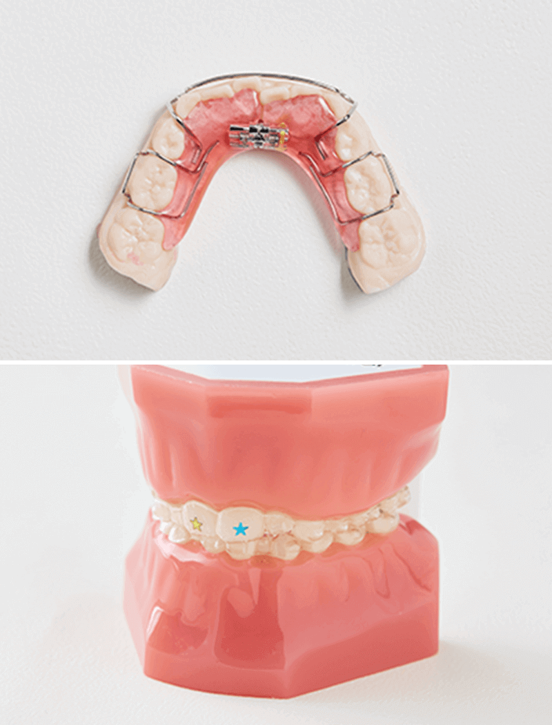 こどもの矯正装置