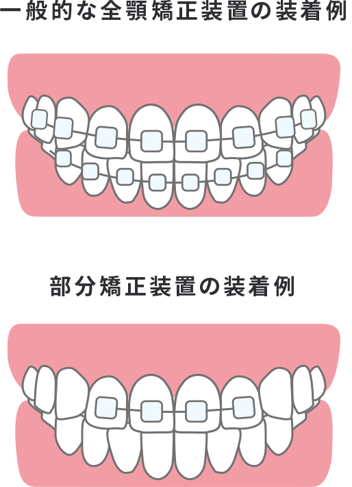 部分矯正